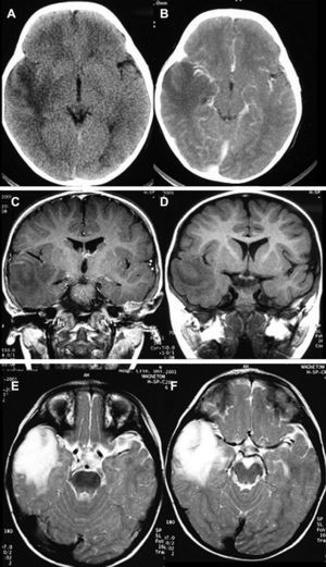 (A) and (B) CAT without and with contrast corresponding to a temporal ganglioglioma. (C) and (D) T1-weighted MRI sequences without and with contrast. (E) and (F) T2-weighted MRI sequences (case 17).