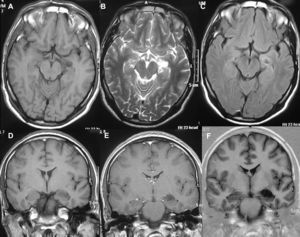 MRI corresponding to a solid GG of the left amygdala. Axial slices in T1-weighted (A), T2-weighted (B) and FLAIR (C) sequences, T1 without and with contrast (D and E) and echogradient (case 10).