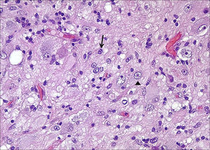 Histology corresponding to a GG showing the glial (arrowhead) and neural (arrow) components (HE 100×).