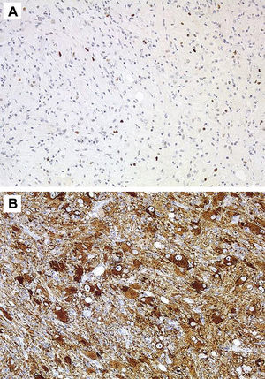 Immunohistochemical stains. (A) Very scant positivity for P53. (B) Positivity for synaptophysin in cells.