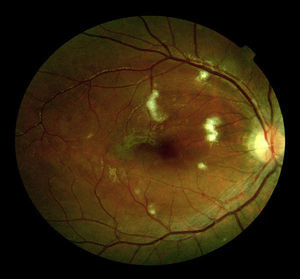 Cotton–wool exudates and macular oedema on ophthalmoscopic examination.