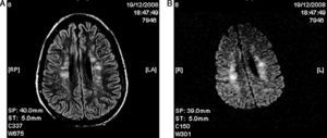 Cerebral MRI. Axial sections in T2 FLAIR and diffusion. (A) Hyperintense foci in periventricular white matter. (B) The same areas as in (A) that show restricted diffusion.
