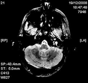 Cerebral MRI (gradient echo sequence, axial section). Spotty hypointensities in both cerebellar hemispheres compatible with micro-haemorrhages.