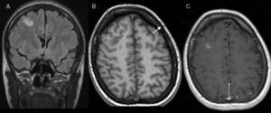 MRI of the brain showing hyperintensity of the FLAIR signal (A) in the grey matter of the right middle frontal gyrus. In T1-weighted EG 3D sequences (B) it is possible to observe a hypointense lesion enhanced after administration of gadolinium in the T1-weighted SE sequence (C).