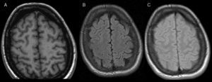 The follow-up study with T1-weighted EG 3D (A), DP (B) and FLAIR (C) sequences, performed after 3 months, shows the disappearance of the findings encountered on the previous MRI.
