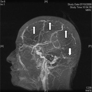 Venous magnetic resonance angiography in sagittal projection showing the absence of superior sagittal and transverse sinus filling in the entire trajectory that corresponds to the cerebral venous thrombosis (arrows).