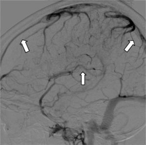 Brain angiography with venous phase digital subtraction. Absence of superior sagittal and inferior sagittal sinus filling. Corresponds to cerebral venous thrombosis in both sinuses (arrows).