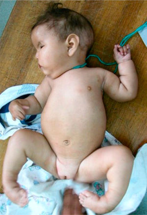 Note the typical phenotype of Moebius–Poland syndrome, hypoplasia of the chest with clubfoot Atelier.