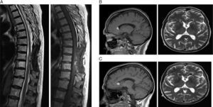 (A) Sagittal T2 and sagittal T1 MRI: between segments D9 and D10, there is a 1-cm lesion situated in the right posterolateral area of the medulla, indicative of a melanin deposit. (B) Sagittal T1 and axial T2 MRI: images indicative of ependymal implants in both anterior horns of the lateral ventricles. (C) Sagittal T1 and axial T2 MRI: increase in the size of the ependymal implants.