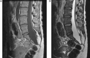 Sagittal plane lumbosacral MRI in T1 (A) and T2 (B) sequences: we see a meningocele with tethered cord, terminal lipoma and posterior sacral dysraphism.