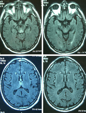 Axial FLAIR images corresponding to Patient 4, showing the typical hyperintensity of periaqueductal and thalamic (left) signals, with clear improvement in the control MRI (right).