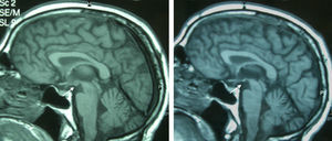 Sagittal T1 images of the same patient, initial and at 9 months, showing atrophy of the mammillary bodies (arrow).