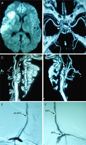 (A) Diffusion MRI scan showing an acute ischemic lesion in the region of the right middle cerebral artery. (B) CT-angiography scan of the circle of Willis showing good filling of intracranial vessels, with tortuous but permeable posterior communicating arteries (arrowhead), as well as retrograde filling of the right carotid siphon and almost no filling of the left siphon (arrow). (C and D) CT-angiography scan of extracranial cerebral arteries showing occlusion of the right (C) and left (D) internal carotid arteries (arrows). (E) Arteriography of the vertebral arteries showing a 40–50% stenosis in the distal third of the right vertebral artery. (F) Image showing 60% stenosis at the origin of the left vertebral artery, as well as 55% stenosis in its distal cervical track.