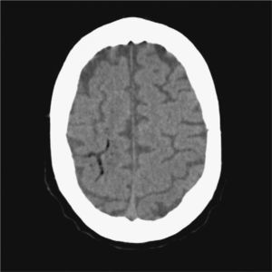 Brain CT scan performed 1h after the onset of symptoms. Serpiginous images with air density in the parietal cortical area.