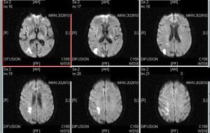 Cranial MRI (diffusion): subacute ischaemic lesion in the posterior territory of the middle cerebral artery (MCA), with involvement of the parietal–occipital cortex and periatrial white matter.