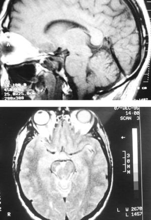 Cranial MRI scan: sagittal T1 section and axial T2 section. Mesencephalic lesion, hypointense on T1 (“black hole”) and hyperintense on T2, at the level of the right substantia nigra.