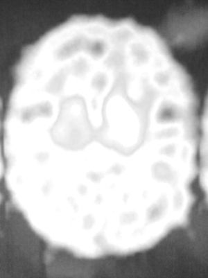 DaTSCAN image. Marked, unilateral, low uptake of the right striatum.