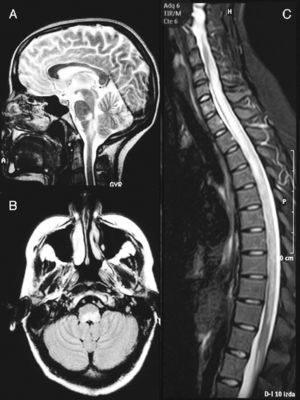 Brain MRI image at the time of diagnosis (February 2003). Sagittal section in T2 (A) and axial FLAIR (B) sequences, revealing an altered signal at the level of the dorsal bulb, exerting a mass effect on the fourth ventricle. (C) Medullar MRI image in STIR sequence without contrast, showing an extensive signal alteration from C4 to L1, with slight mass effect.