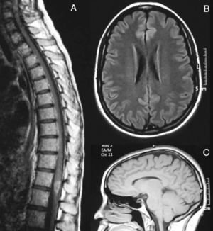 August 2007. (A) Medullar MRI image with intravenous gadolinium. There is a hypodense lesion in T1 sequences, from C2 to D10, with contrast uptake at the level of D8–D9. At the brain level, axial FLAIR (B) and sagittal T1 (C) sequences show no white matter lesions or signs of atrophy.