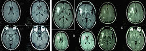 (A) Baseline cranial MRI (FLAIR sequence) taken at the time the patient was diagnosed. (B) Cranial MRI. FLAIR sequences showing infarction in the vascular territory of the RMCA, taken upon patient's first hospitalisation. (C) Cranial MRI. FLAIR sequences taken upon the third hospitalisation.