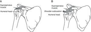 (A) Normal shoulder: the supraspinatus muscle keeps the humeral head inside the glenoid cavity. (B) Shoulder subluxation: during the initial phase of hemiplegia, the supraspinatus is flaccid. The weight of the arm can cause subluxation of the humeral head toward the inferior rim of the glenoid cavity.