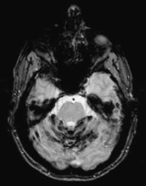 Cerebral magnetic resonance. Pronounced linear hypointense band along the superior cerebellar vermis and hemispheres in a T2-weighted GE sequence that was highly sensitive to the magnetic properties of haemosiderin.