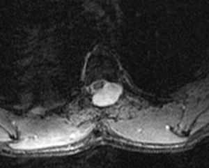 Spinal magnetic resonance image. Laminectomy at the T4–T5 level and left posterolateral pseudomeningocele displacing the spinal cord. The T2-weighted GE sequence reveals a faint peripheral halo of haemosiderin around the spinal cord.