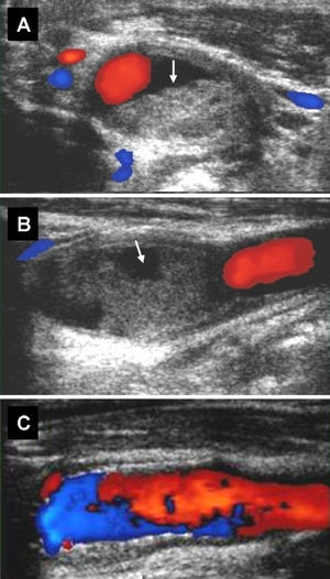 Carotid duplex scan. Image A shows a transverse image of the right carotid bifurcation containing a thrombus (arrow). It can also be seen in the longitudinal view (B), which shows the artery's ulcerated surface (arrow). Blood flow velocities around the thrombus are not indicative of haemodynamically significant stenosis. Image C shows the carotid bifurcation after placement of the stent.