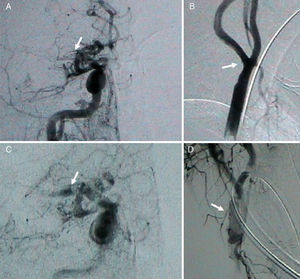 Arteriography. Image A shows the vascular territory of the anterior intracranial artery. Note the lack of blood flow in the entire right middle cerebral artery (RMCA) and its branches (arrow). Image B shows the cervical part of the internal carotid artery and the right carotid bifurcation with signs of mural thrombus (arrow). Image C shows the RMCA after thrombectomy using the Merci retriever. The M1 portion of the RMCA is now visible (arrow). Image D shows the stent placed in the right carotid bifurcation (arrow).