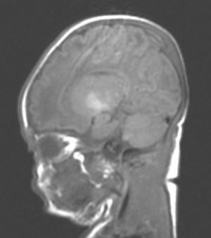 Sagittal MRI image (T1-weighted). Clear hyperintensity in the globus pallidus and faint hyperintensity in subthalamic nucleus (Case 5).