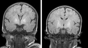Coronal MRI, T2-weighted FLAIR sequence. Hyperintensity in globi pallidi (Cases 1 and 3).