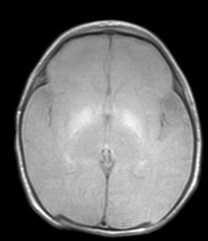 Axial MRI, T2-weighted sequence. Symmetrical hyperintensity in globi pallidi (Case 1).