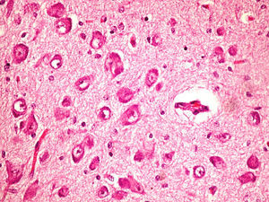 Optical microscope image (globus pallidus) (Case 3). Degenerative neuronal changes showing neuronal loss and astrocytosis.