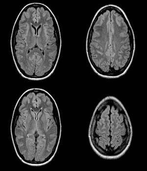Magnetic resonance image (FLAIR) showing sulcal hyperintensity of the convexity in the frontal and occipital parasagittal regions.