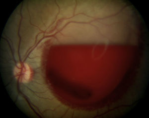 Large subhyaloid haemorrhage of the left eye found in an examination of the back of the eye.