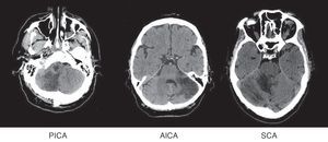 Brain CT: examples of cerebellar infarcts from each of the territories.
