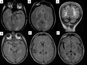 (A–C) Hyperintense parietal-occipital lesions in T2-weighted and FLAIR sequences in the first episode. (D–E) Disappearance of lesions in MR image taken one month later. (F) New right occipital lesion, hyperintense in FLAIR sequence, in a second episode 6 months later.