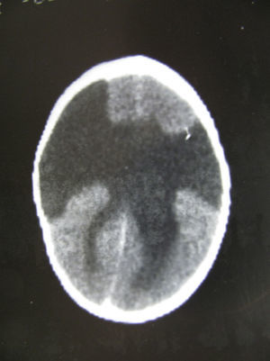 Case 1: Neonate with intrauterine cytomegalovirus. Axial CT slice showing sizeable bilateral open-lipped schizencephaly and a large central defect with an absent corpus callosum and septum pellucidum.