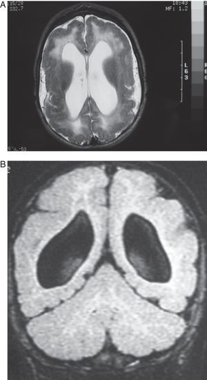 Case 4: Patient aged 5 months with intrauterine cytomegalovirus. MR study. (A) the T2-weighted axial slice shows pachygyria- and polymicrogyria-type cortical malformations, dilation of lateral ventricles, and diffuse hyperintense image in the white matter in both hemispheres. (B) T1-weighted coronal section of the same study, showing few gyri, the considerable width of the cortical grey matter (polymicrogyria) and substantial passive dilation and roundness of lateral ventricles.