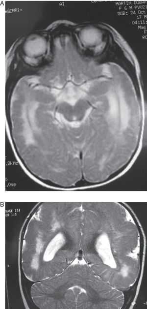 Case 5: Patient aged 6 months. (A) MR axial section at level of the base of the brain showing a wide hyperintense zone in the white matter on both hemispheres. (B) T2-weighted coronal section of the same study. Note the cortical abnormalities and diffuse hyperintensity in the white matter, predominantly in the posterior and anterior areas of the brain.