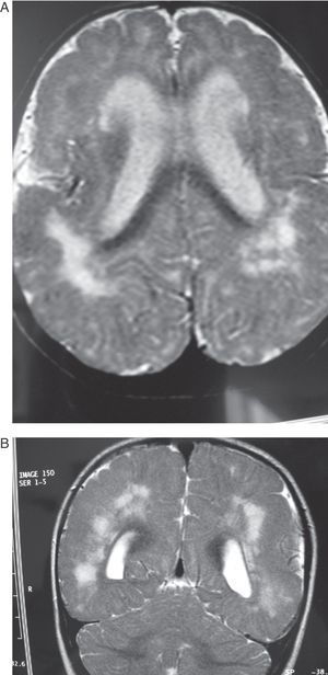 Same patient as in Fig. 3 at the age of one year. (A) The axial slice shows the same cortical and subcortical alterations that were visible at 6 months, but hyperintensity of the white matter lesions has decreased. (B) The coronal slice also shows alterations in the white matter similar to those seen at 6 months.