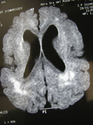 Same patient as in Figs. 3 and 4 at age two and a half. The axial section of the T1-weighted MR image shows cortical alterations similar to those observed in the patient at 6 months and 1 year; the hyperintense zones are more concentrated within a number of areas, especially in posterior areas.