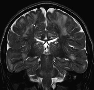 T2-weighted coronal plane MRI (FSE-T2). Note the hyperintense signals in T2 on the supratentorial white matter and marked dilation of perivascular Virchow–Robin spaces (arrow) in a patient with Hunter syndrome.