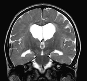T2-weighted coronal plane MRI (FSE-T2). We identified supratentorial ventriculomegaly and dilation of perivascular Virchow–Robin spaces in a patient with severe Hunter syndrome aged 5 and a half.