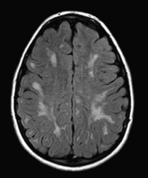 Brain MRI of a child with moderate Hunter syndrome showing multiple patchy white matter lesions in the periventricular and subcortical areas. Age: 11 years.