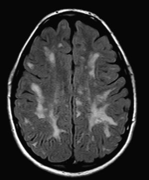 Same patient as in previous figure, 1 year later. Note the minimal progression of multiple confluent areas of hypersignal in periventricular white matter, centrum semiovale, and corona radiata.