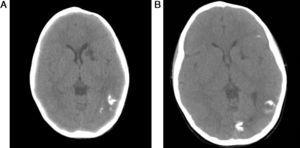 Brain CT: (A) At 4 years of age and (B) at 7 years of age.