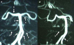 MR angiography images in the posterior fossa (see description in text).