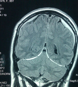 MRI FLAIR sequence. Bilateral subdural hygromas.