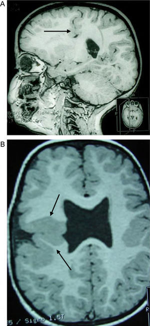 Case 3: unilateral closed-lip schizencephaly in a 2-year-old girl with slight motor impairment on the left side of the body. 3D MRI. (A) Sagittal slice showing closed lips cutting an irregular path from the cortex to the lateral ventricle (arrow). (B) Axial slice showing extensive cortical–subcortical dysplasia in the right hemisphere extending from the sunken area of the cortex to the lateral ventricular wall. The profile is irregular, but this slice does not allow us to see the fused schizencephalic cleft. Small cortical dysplasia with cortical irregularity (arrows).